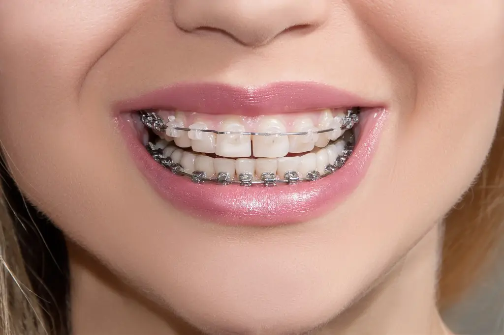 braces-make-my-teeth-loose-1