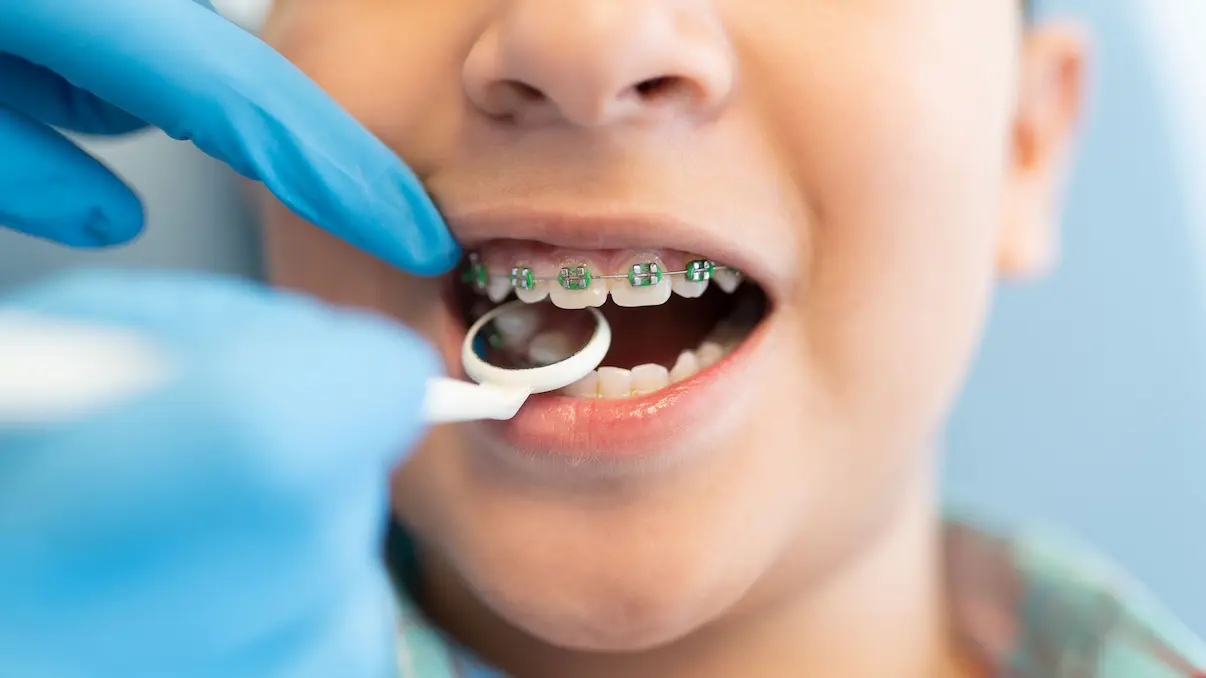 مراقبت های اولیه ارتودنسی در سن 7 سالگی: راهی برای درمان مقرون به صرفه